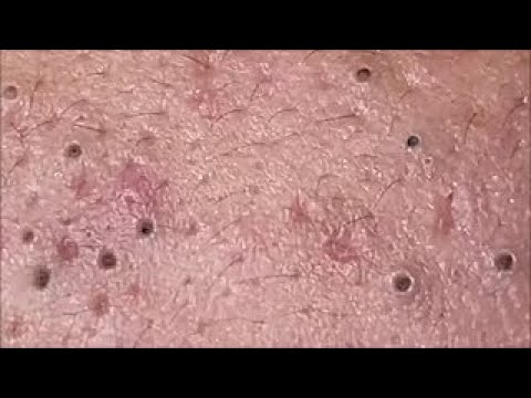 Relaxing Pimple Popping Today. EP06