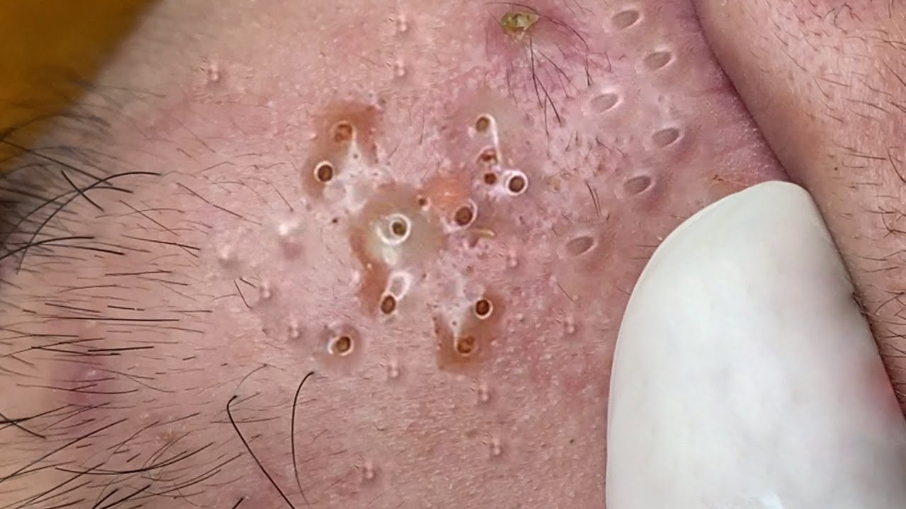 Relaxing Pimple Popping Today. EP02